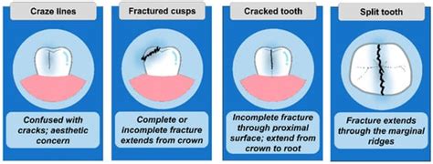 To Crack or Not to Crack, A Common Question .